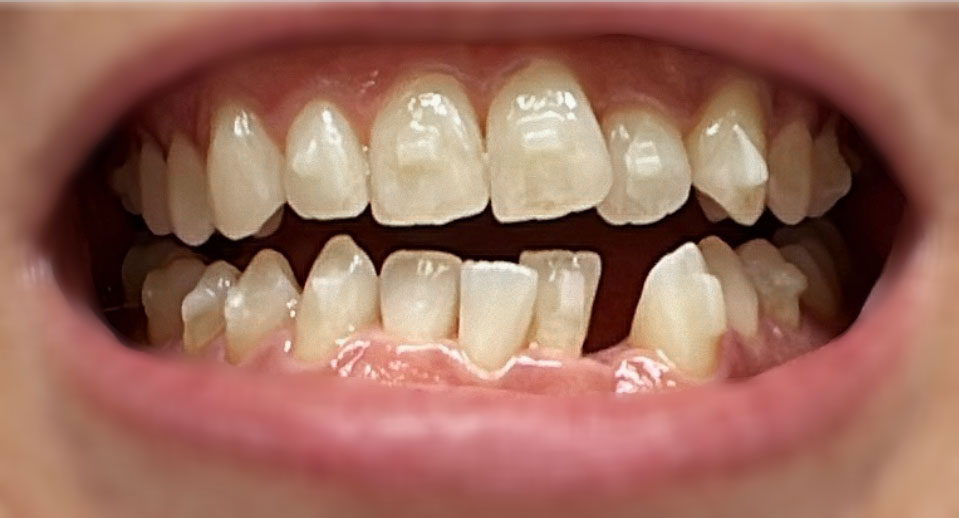 invisalign インビザライン アメリカ 一年 ビフォーアフター